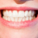 Zářivě bílé zuby docílíte díky správné péči